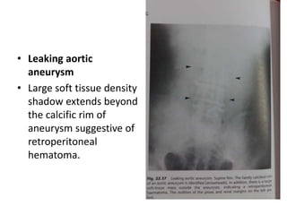 • Leaking aortic
aneurysm
• Large soft tissue density
shadow extends beyond
the calcific rim of
aneurysm suggestive of
retroperitoneal
hematoma.
 