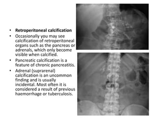 • Retroperitoneal calcification
• Occasionally you may see
calcification of retroperitoneal
organs such as the pancreas or
adrenals, which only become
visible when calcified.
• Pancreatic calcification is a
feature of chronic pancreatitis.
• Adrenal (suprarenal)
calcification is an uncommon
finding and is usually
incidental. Most often it is
considered a result of previous
haemorrhage or tuberculosis.
 