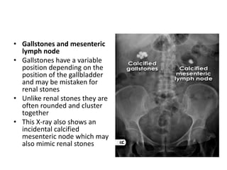 • Gallstones and mesenteric
lymph node
• Gallstones have a variable
position depending on the
position of the gallbladder
and may be mistaken for
renal stones
• Unlike renal stones they are
often rounded and cluster
together
• This X-ray also shows an
incidental calcified
mesenteric node which may
also mimic renal stones
 