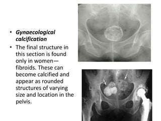 • Gynaecological
calcification
• The final structure in
this section is found
only in women—
fibroids. These can
become calcified and
appear as rounded
structures of varying
size and location in the
pelvis.
 