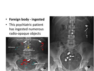 • Foreign body - ingested
• This psychiatric patient
has ingested numerous
radio-opaque objects
 
