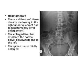 • Hepatomegaly
• There is diffuse soft tissue
density shadowing in the
right upper quadrant due
to hepatomegaly (liver
enlargement)
• The enlarged liver has
displaced the normal
bowel downwards and to
the left
• The spleen is also mildly
enlarged
 