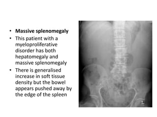 • Massive splenomegaly
• This patient with a
myeloproliferative
disorder has both
hepatomegaly and
massive splenomegaly
• There is generalised
increase in soft tissue
density but the bowel
appears pushed away by
the edge of the spleen
 