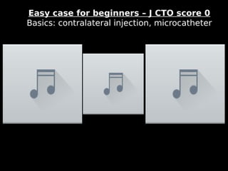 12
Easy case for beginners – J CTO score 0
Basics: contralateral injection, microcatheter