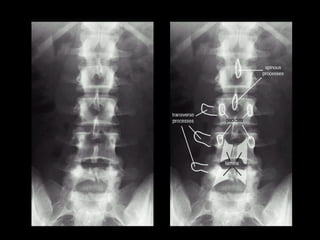 Planchage_radiologie_ostéo_articulaire_10_rachisFFFFFFFFFFFFFFFFFFF.pdf