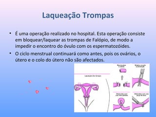 Laqueação Trompas
• É uma operação realizado no hospital. Esta operação consiste 
em bloquear/laquear as trompas de Falópio, de modo a 
impedir o encontro do óvulo com os espermatozóides. 
• O ciclo menstrual continuará como antes, pois os ovários, o 
útero e o colo do útero não são afectados. 
 