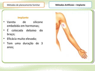 Métodos de planeamento familiar   Métodos Artificiais – Implante




            Implante
• Vareta      de      silicone
  embebida em hormonas;
• É colocada debaixo do
  braço;
• Eficácia muito elevada;
• Tem uma duração de 3
  anos;
 