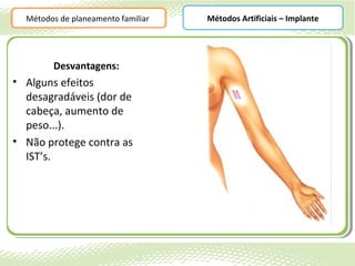 Métodos de planeamento familiar   Métodos Artificiais – Implante




        Desvantagens:
• Alguns efeitos
  desagradáveis (dor de
  cabeça, aumento de
  peso...).
• Não protege contra as
  IST’s.
 