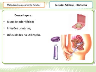 Métodos de planeamento familiar   Métodos Artificiais – Diafragma



        Desvantagens:

• Risco de odor fétido;

• Infeções urinárias;

• Dificuldades na utilização.
 