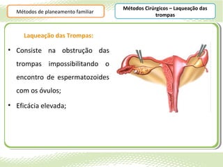 Métodos Cirúrgicos – Laqueação das
  Métodos de planeamento familiar
                                                 trompas


     Laqueação das Trompas:

• Consiste na obstrução das
  trompas impossibilitando o
  encontro de espermatozoides
  com os óvulos;
• Eficácia elevada;
 
