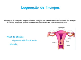 Laqueação de trompas


A laqueação de trompas é um procedimento cirúrgico que consiste na oclusão bilateral das trompas
    de Falópio, impedindo assim que os espermatozoides entrem em contacto com óvulo.




    Nível de eficácia:
           O grau de eficácia é muito
        elevado.
 