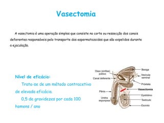 Vasectomia

   A vasectomia é uma operação simples que consiste no corte ou ressecção dos canais
deferentes responsáveis pelo transporte dos espermatozoides que são expelidos durante
a ejaculação.




   Nível de eficácia:
       Trata-se de um método contracetivo
   de elevada eficácia.
       0,5 de gravidezes por cada 100
   homens / ano
 