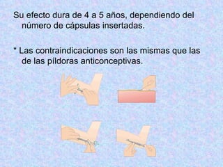 Su efecto dura de 4 a 5 años, dependiendo del número de cápsulas insertadas.  * Las contraindicaciones son las mismas que las de las píldoras anticonceptivas.  