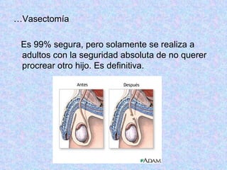 … Vasectomía Es 99% segura, pero solamente se realiza a adultos con la seguridad absoluta de no querer procrear otro hijo. Es definitiva. 