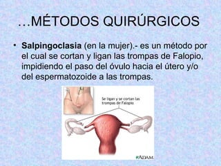 … MÉTODOS QUIRÚRGICOS  Salpingoclasia  (en la mujer).- es un método por el cual se cortan y ligan las trompas de Falopio, impidiendo el paso del óvulo hacia el útero y/o del espermatozoide a las trompas.  