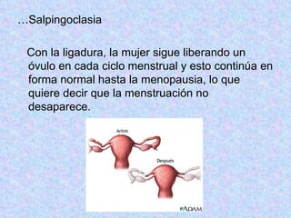 … Salpingoclasia Con la ligadura, la mujer sigue liberando un óvulo en cada ciclo menstrual y esto continúa en forma normal hasta la menopausia, lo que quiere decir que la menstruación no desaparece.  