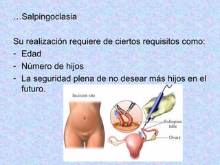 … Salpingoclasia Su realización requiere de ciertos requisitos como:  Edad Número de hijos La seguridad plena de no desear más hijos en el futuro.  