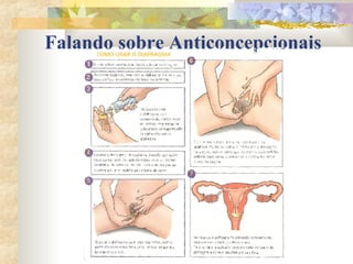 Falando sobre Anticoncepcionais 