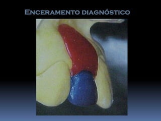 Enceramento diagnóstico
 