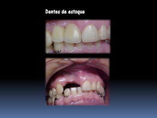 Dentes de estoque
 