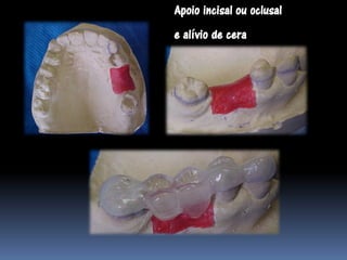 Apoio incisal ou oclusal
e alívio de cera
 