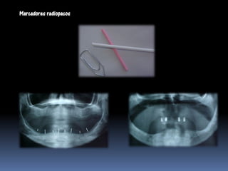 Marcadores radiopacos
 