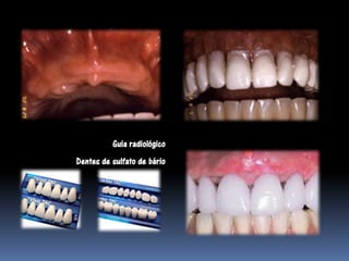 Guia radiológico
Dentes de sulfato de bário
 