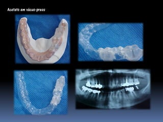 Acetato em vácuo-press
 