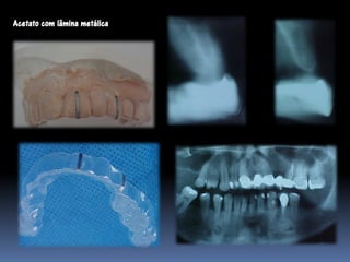 Acetato com lâmina metálica
 