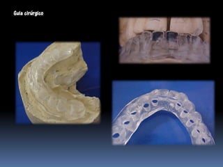 Guia cirúrgico
 