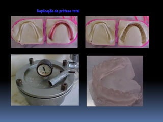 Duplicação de prótese total
 