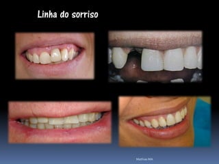 Linha do sorriso




                   Mathias MA
 