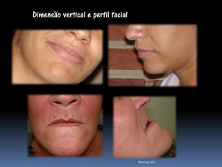 Dimensão vertical e perfil facial




                                    Mathias MA
 