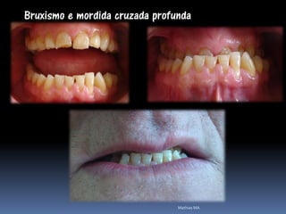 Bruxismo e mordida cruzada profunda




                                Mathias MA
 