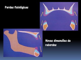 Perdas fisiológicas




                      Novas dimensões de
                      rebordos
 