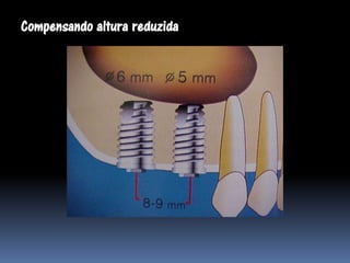 Compensando altura reduzida
 