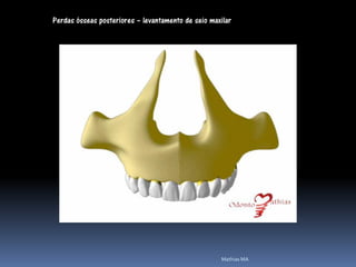 Perdas ósseas posteriores – levantamento de seio maxilar




                                                    Mathias MA
 