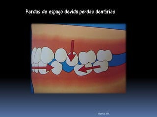 Perdas de espaço devido perdas dentárias




                                Mathias MA
 