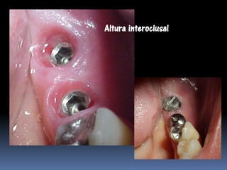 Altura interoclusal
 