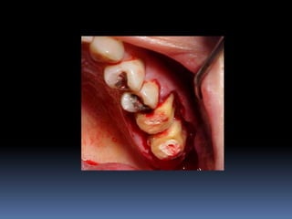 Aumento de coroa clínica
 
