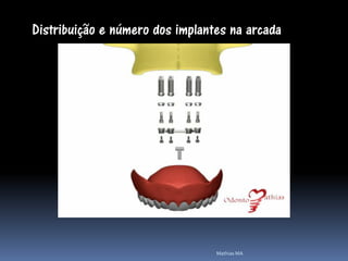 Distribuição e número dos implantes na arcada




                                 Mathias MA
 