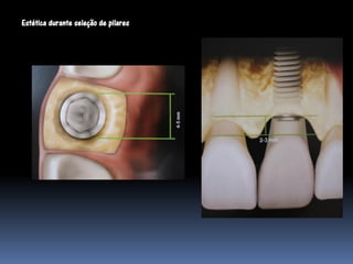 Estética durante seleção de pilares
 