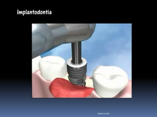 Implantodontia




                 Mathias MA
 