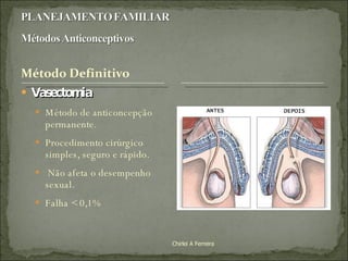 Vasectomia Método de anticoncepção permanente.  Procedimento cirúrgico simples, seguro e rápido. Não afeta o desempenho sexual.  Falha < 0,1% Chirlei A Ferreira 