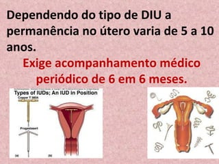 Dependendo do tipo de DIU a permanência no útero varia de 5 a 10 anos. Exige acompanhamento médico periódico de 6 em 6 meses. 