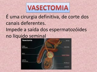 É uma cirurgia definitiva, de corte dos canais deferentes. Impede a saída dos espermatozóides no líquido seminal 