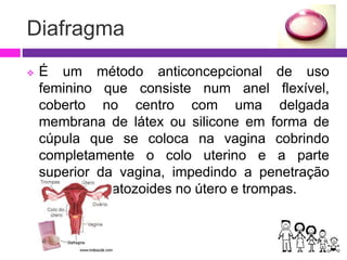 Diafragma
 É um método anticoncepcional de uso
feminino que consiste num anel flexível,
coberto no centro com uma delgada
membrana de látex ou silicone em forma de
cúpula que se coloca na vagina cobrindo
completamente o colo uterino e a parte
superior da vagina, impedindo a penetração
dos espermatozoides no útero e trompas.
 