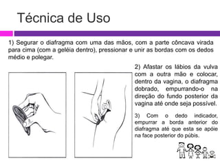 Técnica de Uso
1) Segurar o diafragma com uma das mãos, com a parte côncava virada
para cima (com a geléia dentro), pressionar e unir as bordas com os dedos
médio e polegar.
2) Afastar os lábios da vulva
com a outra mão e colocar,
dentro da vagina, o diafragma
dobrado, empurrando-o na
direção do fundo posterior da
vagina até onde seja possível.
3) Com o dedo indicador,
empurrar a borda anterior do
diafragma até que esta se apóie
na face posterior do púbis.
 