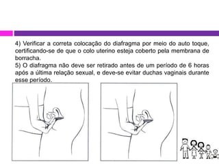 4) Verificar a correta colocação do diafragma por meio do auto toque,
certificando-se de que o colo uterino esteja coberto pela membrana de
borracha.
5) O diafragma não deve ser retirado antes de um período de 6 horas
após a última relação sexual, e deve-se evitar duchas vaginais durante
esse período.
 