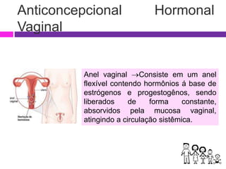 Anticoncepcional Hormonal
Vaginal
Anel vaginal Consiste em um anel
flexível contendo hormônios á base de
estrógenos e progestogênos, sendo
liberados de forma constante,
absorvidos pela mucosa vaginal,
atingindo a circulação sistêmica.
 